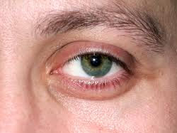 Eye Laser Surgery Side Effects